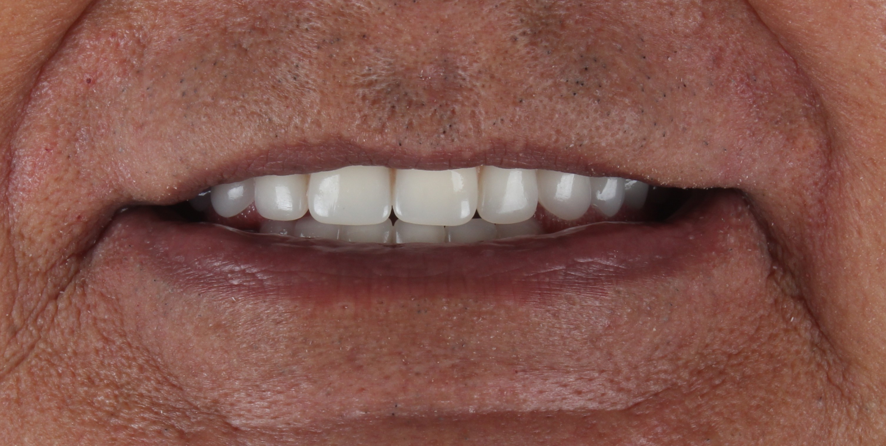 Depois da prótese total